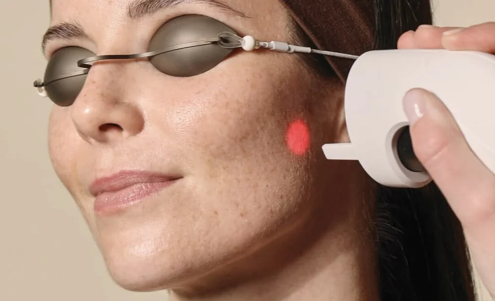 A laser handpiece aimed at a woman's cheek, her eyes covered by protective goggles